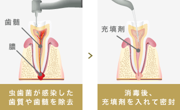 虫歯菌が感染した歯質や歯髄を除去＞消毒後、充填剤を入れて密封