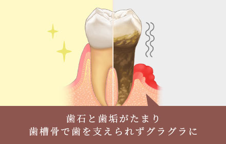 歯石と歯垢がたまり歯槽骨で歯を支えられずグラグラに