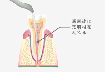 消毒後に充填材を入れる